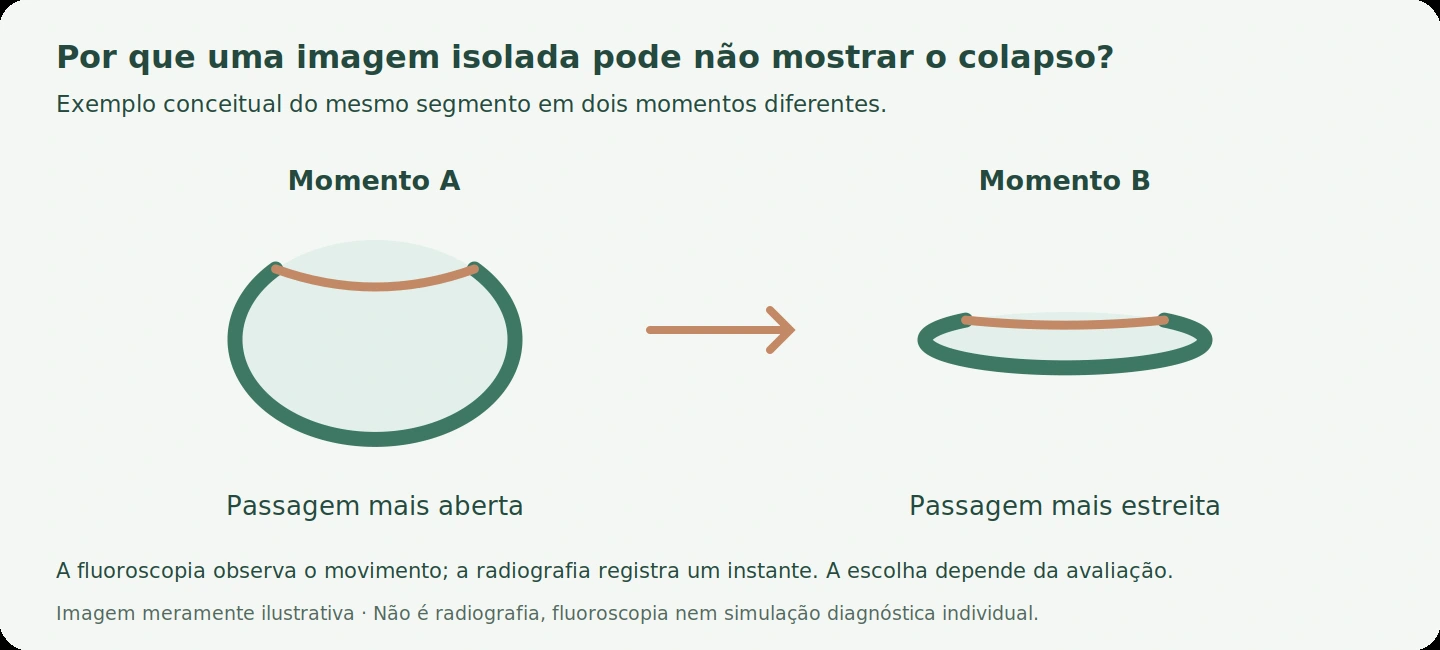 Mesmo segmento traqueal representado mais aberto e mais estreito em dois momentos diferentes.