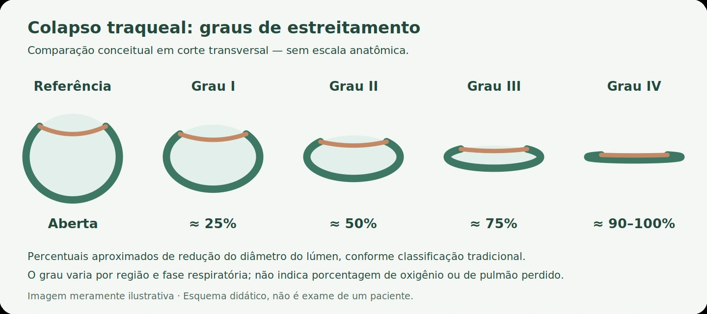 Esquema conceitual dos graus I, II, III e IV de estreitamento da traqueia.