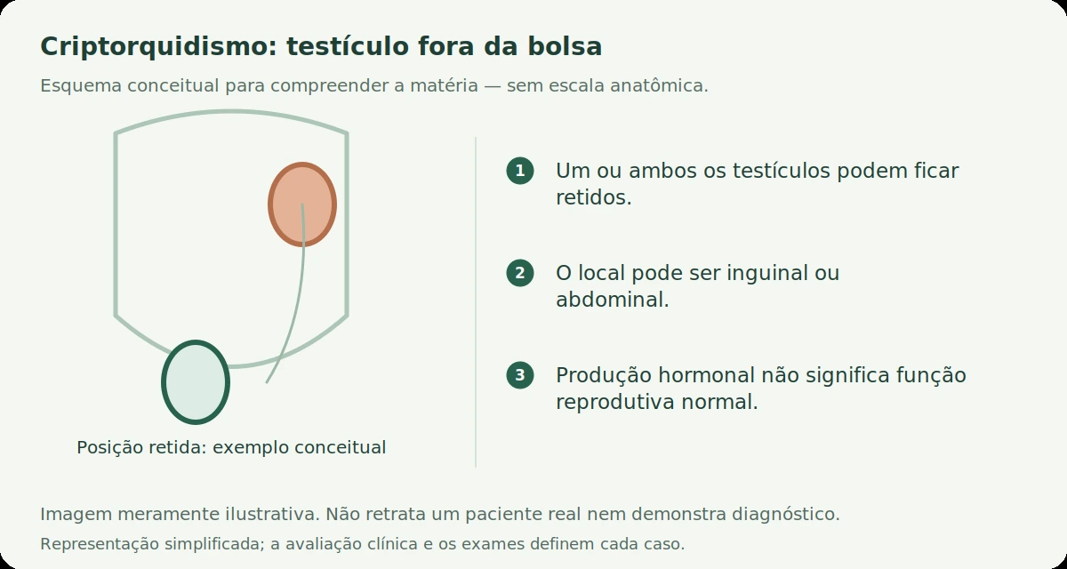Esquema conceitual: Criptorquidismo: o testículo que não desceu precisa ser retirado?