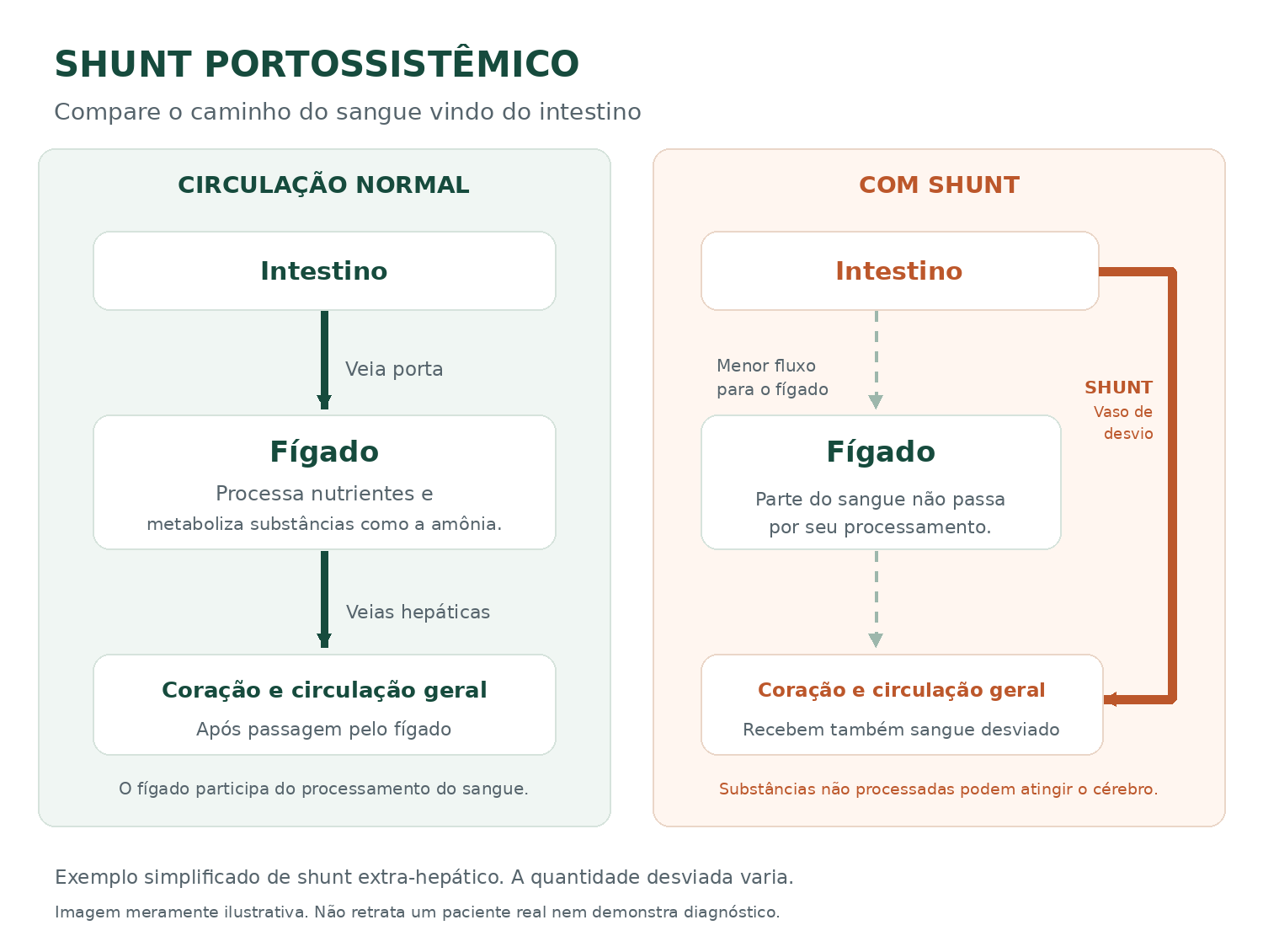 Comparativo: intestino, veia porta, fígado e circulação no trajeto normal; no shunt, um vaso permite desvio parcial ao redor do fígado