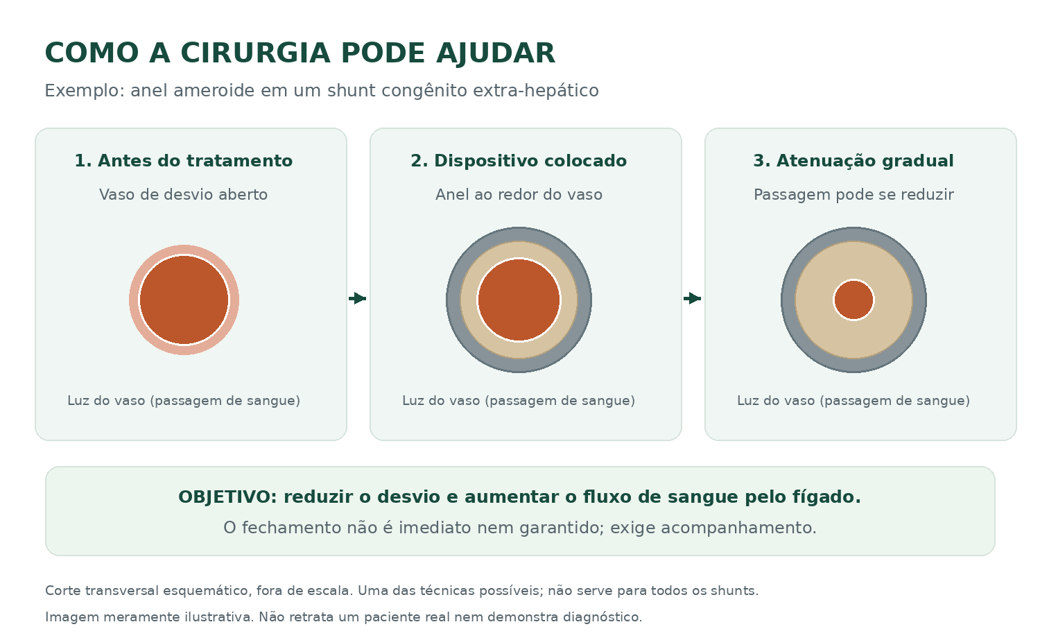 Exemplo esquemático de cirurgia: vaso de desvio aberto, anel ameroide ao redor do vaso e redução gradual da passagem